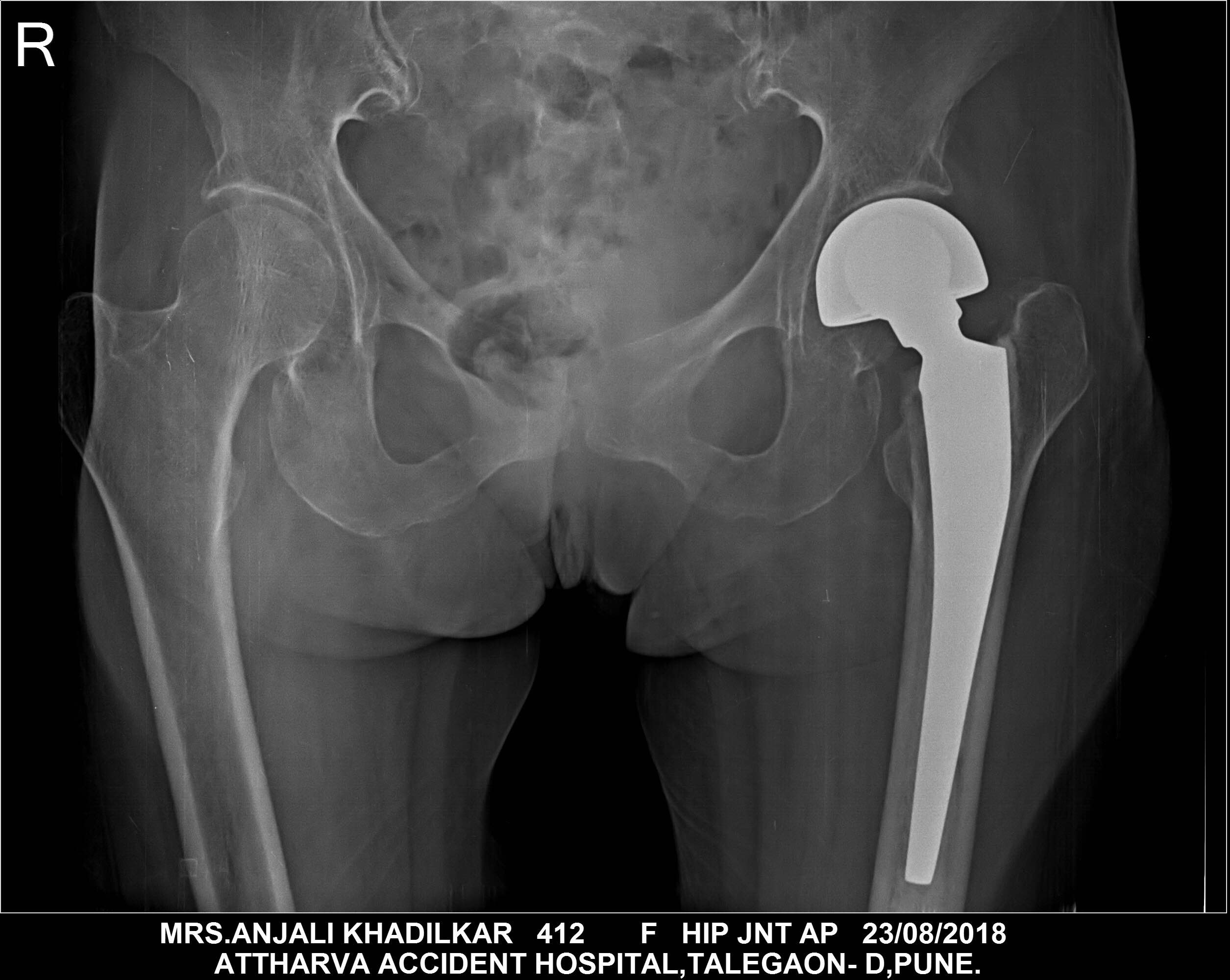 Post ops xray mrs Anjali Khadilkar main image