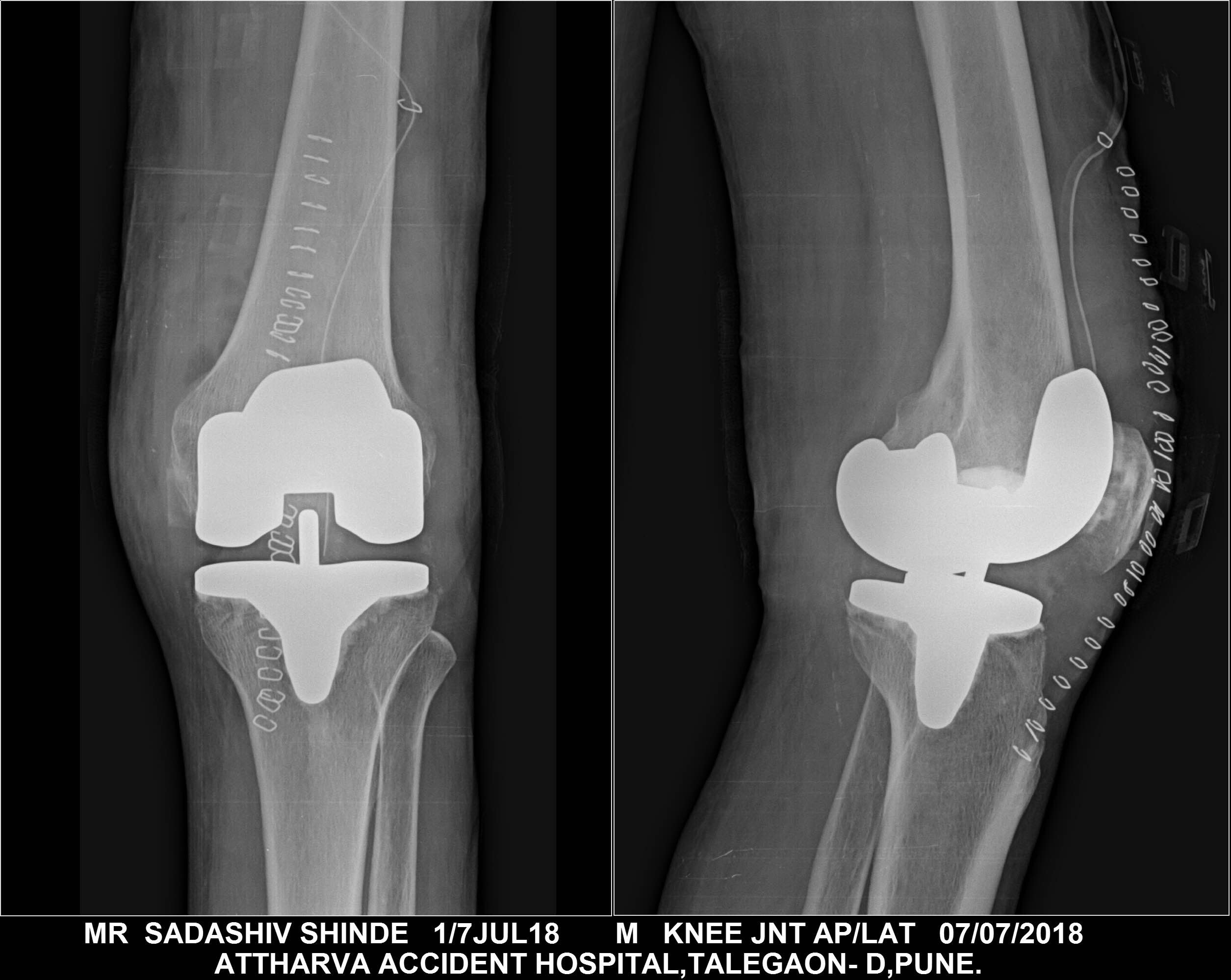  Post ops xray Mr Sadashiv Shinde main image