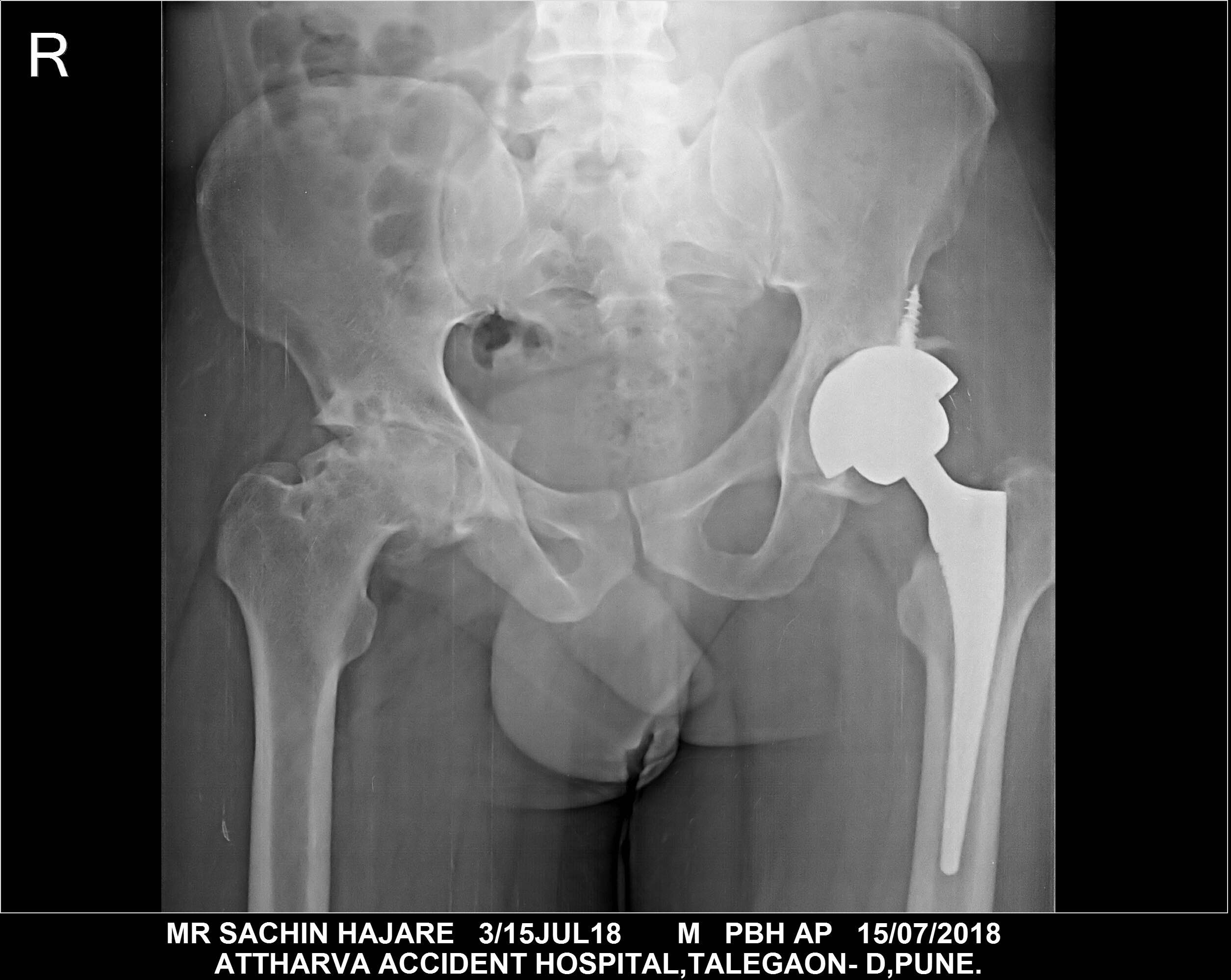 Post ops xray Mr Sachin Hajare. Single Hip Repl... main image
