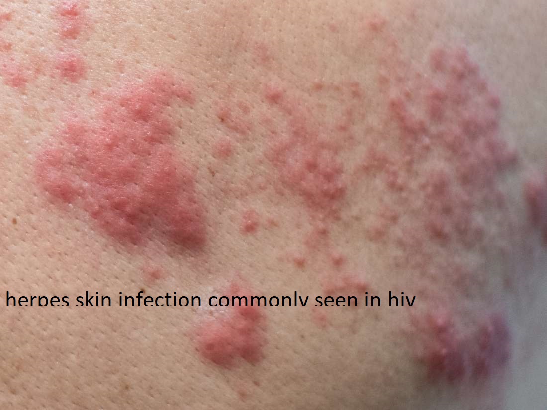 Herpes skin infection is commonly seen in hiv p... main image