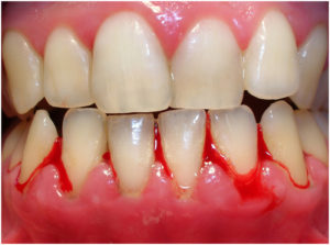 Is bleeding gums making you brush gently in those ... main image