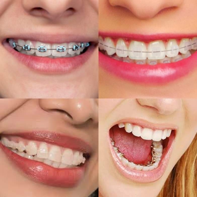 Thinking whether braces treatment might be need... main image