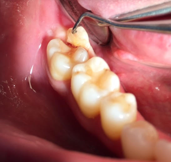 How much time can I last with a chipped/broken molar? r/Dentistry
