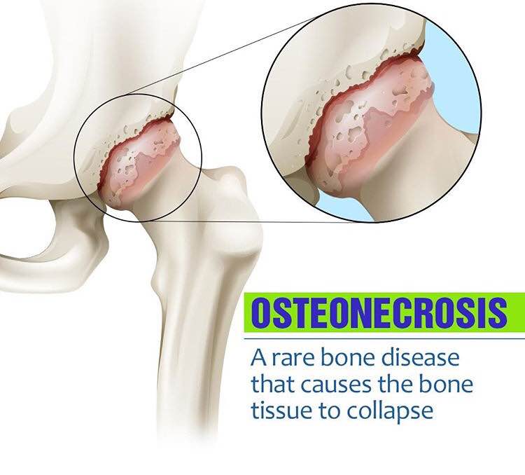 Osteonecrosis is a bone disease where the bone ... main image