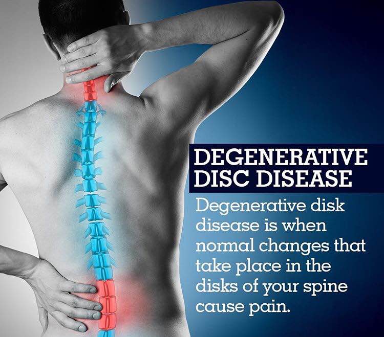 Spinal disks are like shock absorbers between t... main image