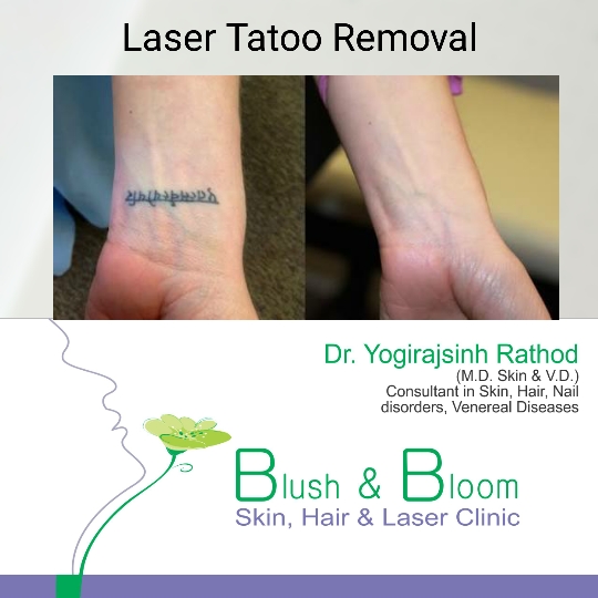 Tatoo removal got easier........
Think_Skin_Think_... main image