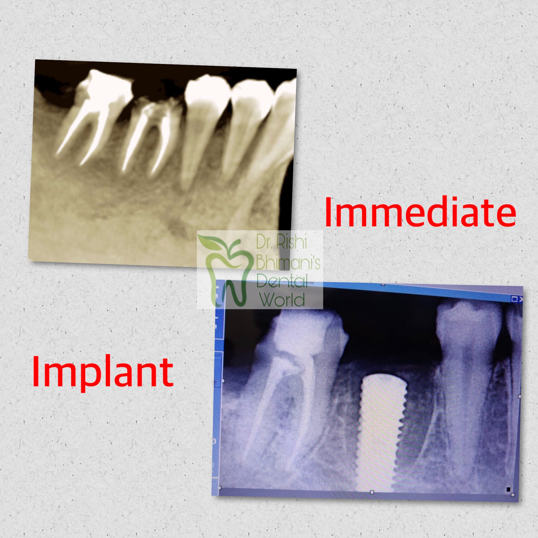 Broken or fractured teeth that cannot be saved,... main image
