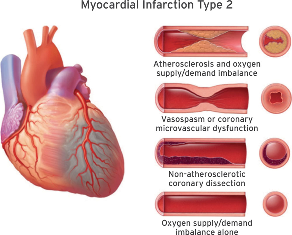 Myocardial Infarction
