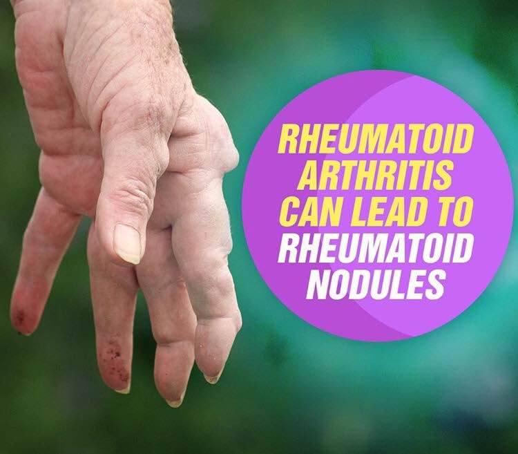 About 20% of women with RA develop these nodule... main image