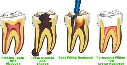 Root canal is a treatment to repair and save a bad... main image