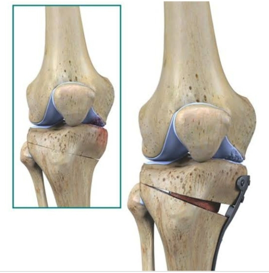 OSTEOTOMY IS A SURGICAL OPERATION WHERE BONE IS... main image