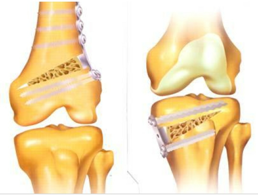 OSTEOTOMY AROUND KNEE IS DONE TO PRESERVE NATUR... main image