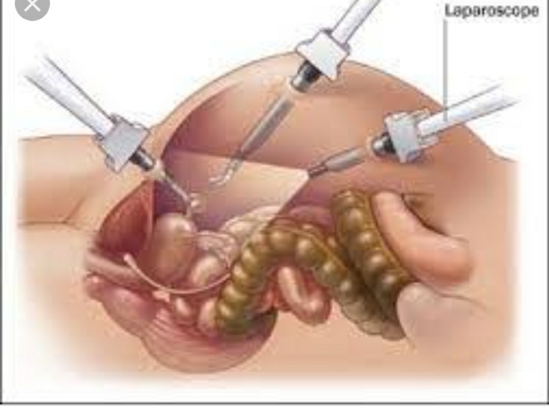 LAPROSCOPY SURGERIES ARE KEY HOLE SURGERIES FOR... main image