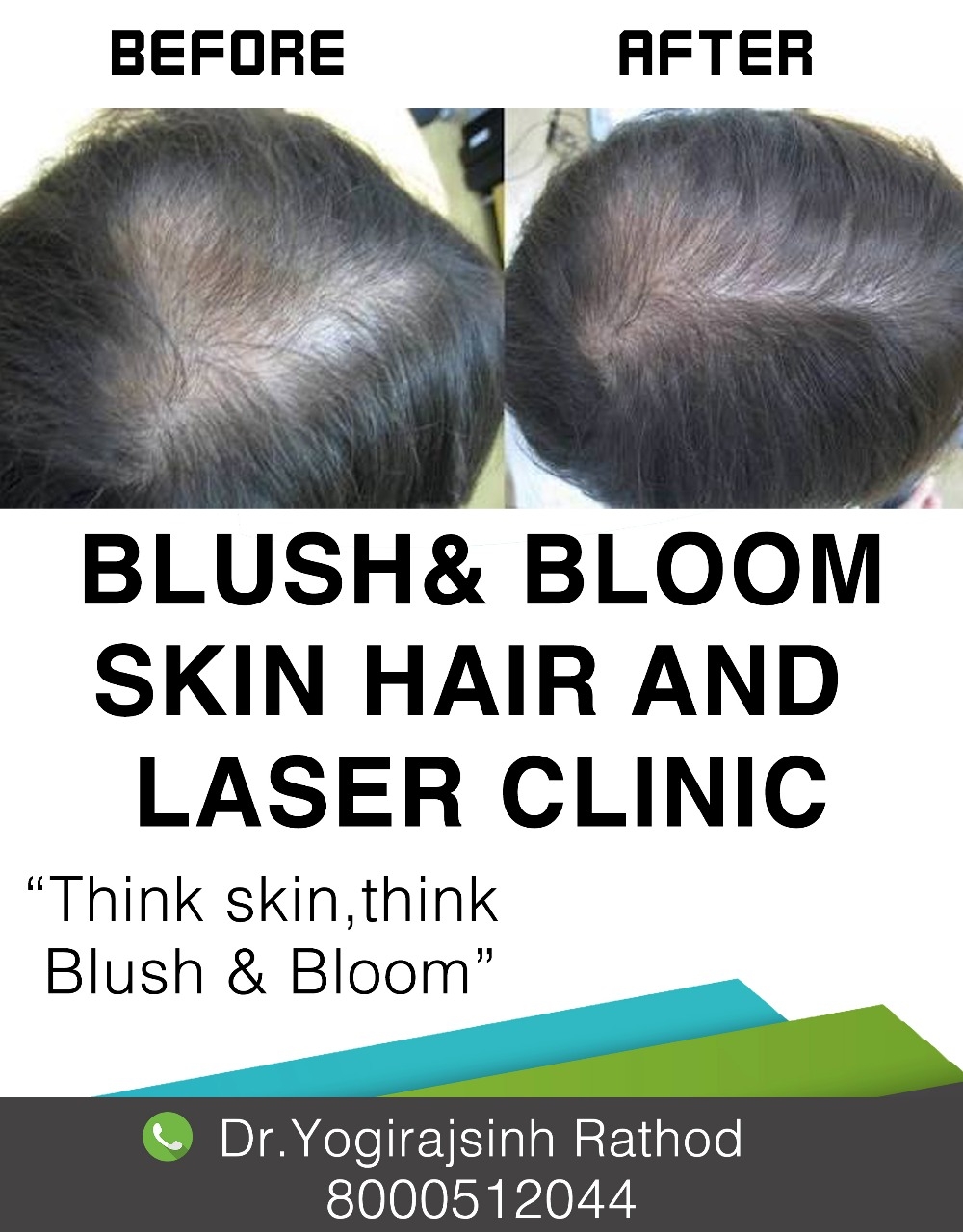 Mesotherapy for hair regrowth.....
Think_Skin_Thin... main image