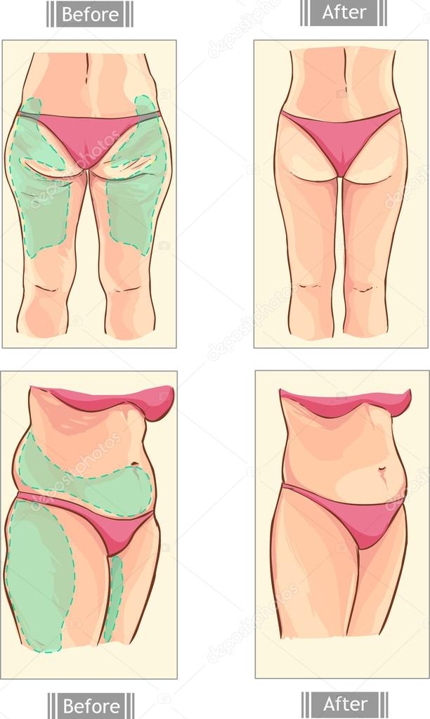 Liposuction 
Rhinoplasty 
Implants 
Tummytuck 
Gyn... main image