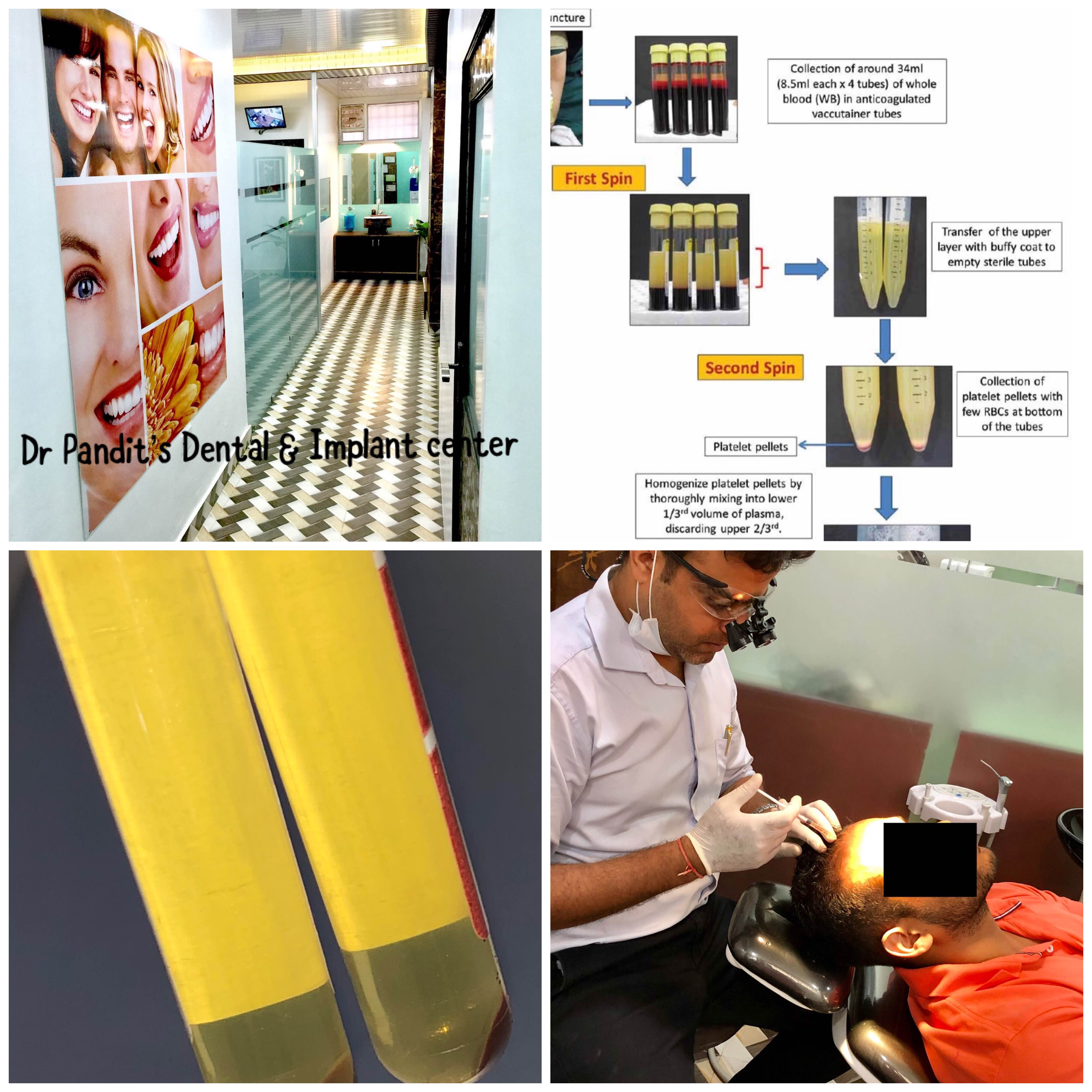 PRP ( Platelet rich plasma) therapy for hair loss ... main image