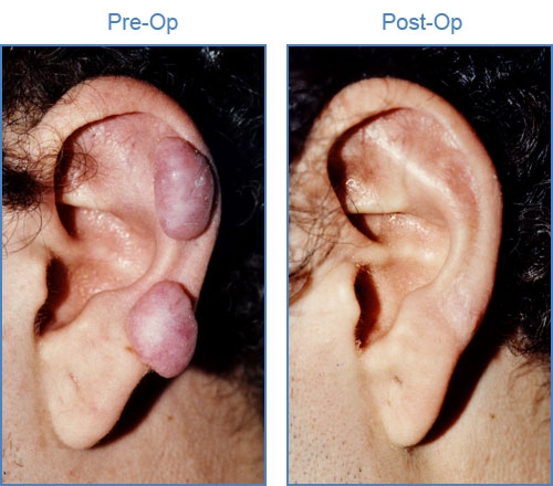 Keloid surgery......get the original shape agai... main image