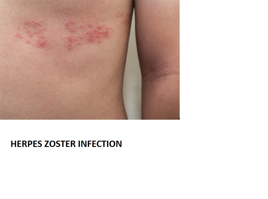 HERPES ZOSTER INFECTION IS COMMONLY SEEN IN HIV... main image