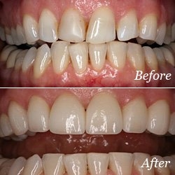 TRANSFORM YOUR SMILE WITH DENTAL VENEERS
Dental v... main image