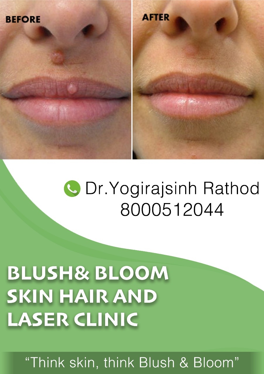 Mole removal- no stitches, no dressing.....
Think_... main image