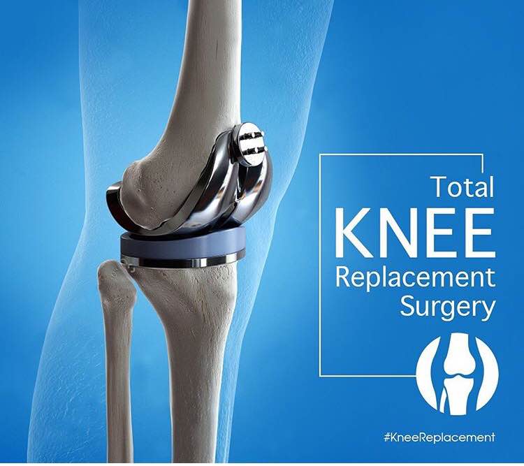 Knee replacement surgery is one of the most com... main image