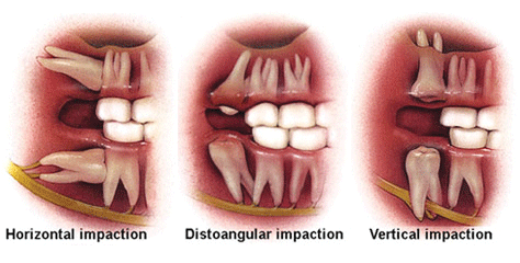 WISDOM TEETH PROBLEM