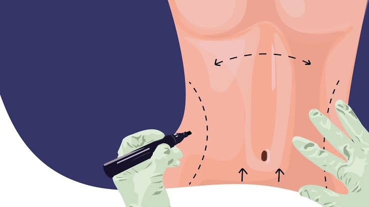 Liposuction 
Rhinoplasty 
Implants 
Tummytuck 
Gyn... main image