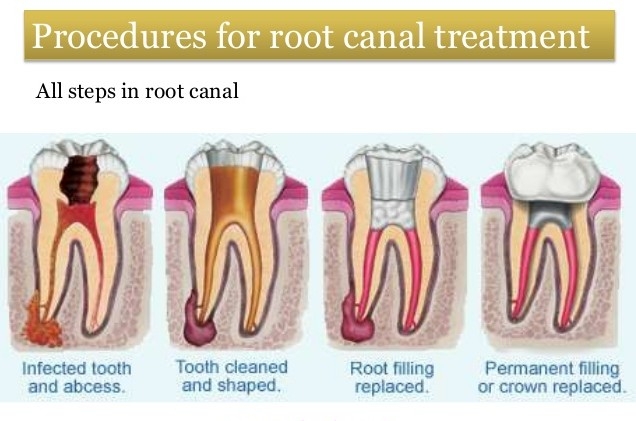 Root canal reatment helps to maintain your natu... main image