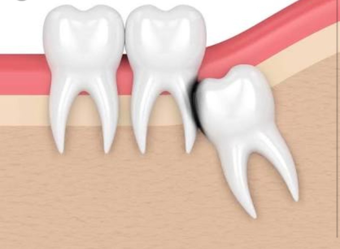 A wisdom tooth that does not have space to erup... main image
