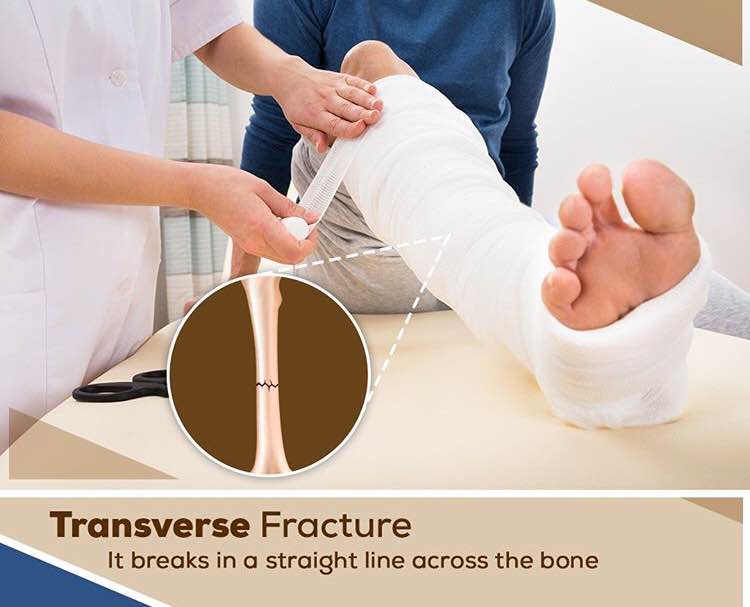 This type of fracture occurs due to the applica... main image