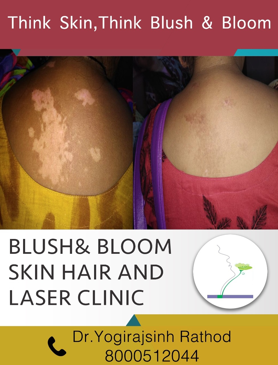 Vitiligo is curable.....
Think_Skin_Think_Blush_& ... main image