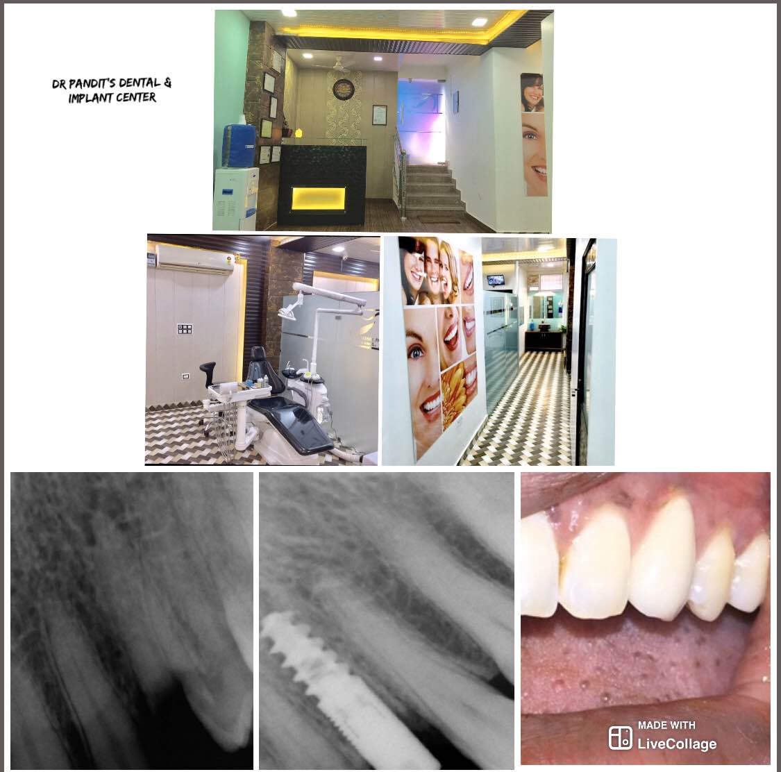 Dental implants are safe and best option to replac... main image