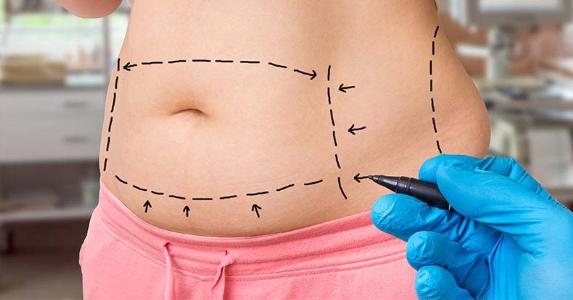 Liposuction 
Rhinoplasty 
Implants 
Tummytuck 
Gyn... main image