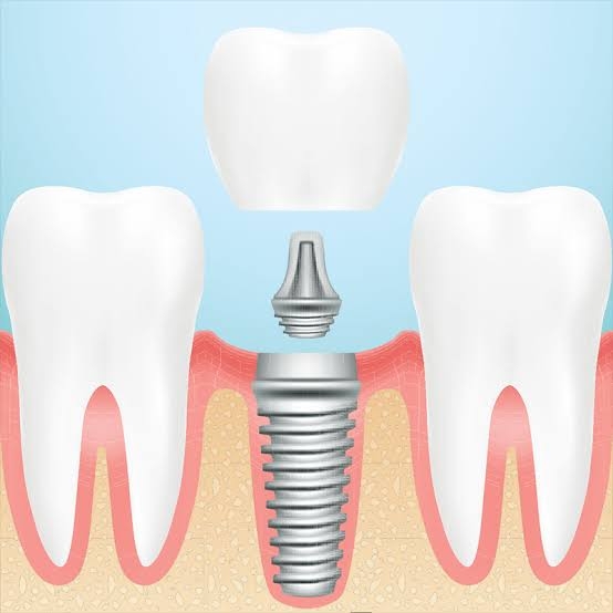 When you lose a tooth, it creates a vacant spac... main image