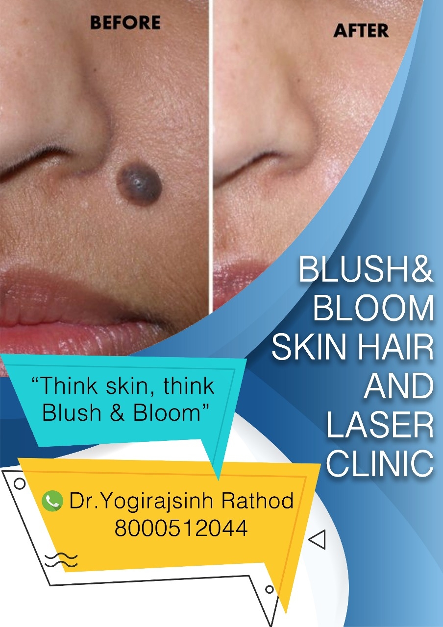 Mole removal......
Think_Skin_Think_Blush_& _Bl... main image