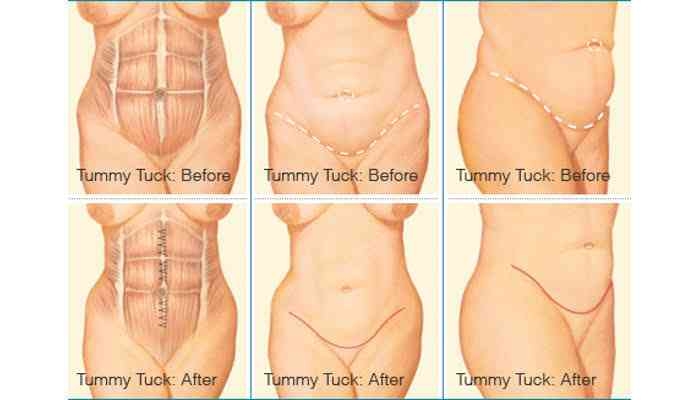 Liposuction 
Rhinoplasty 
Implants 
Tummytuck 
Gyn... main image