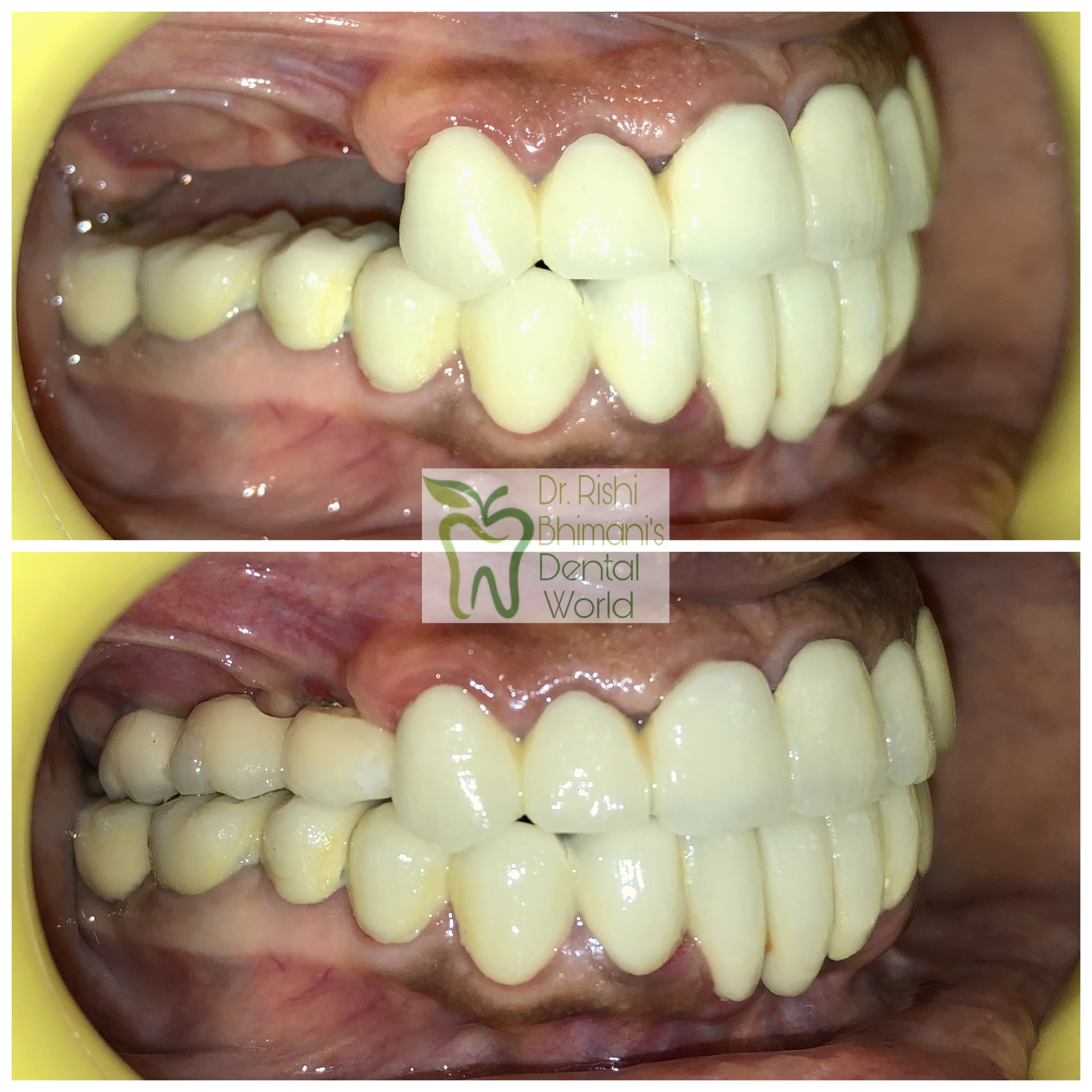 DENTAL IMPLANTS IN N