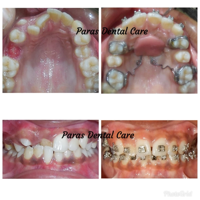 Not all of us are born with well aligned teeth ... main image