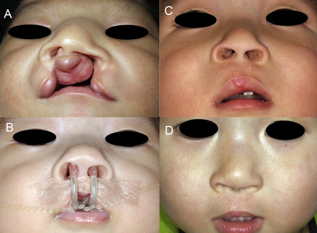 Liposuction 
Rhinoplasty 
Implants 
Tummytuck 
Gyn... main image