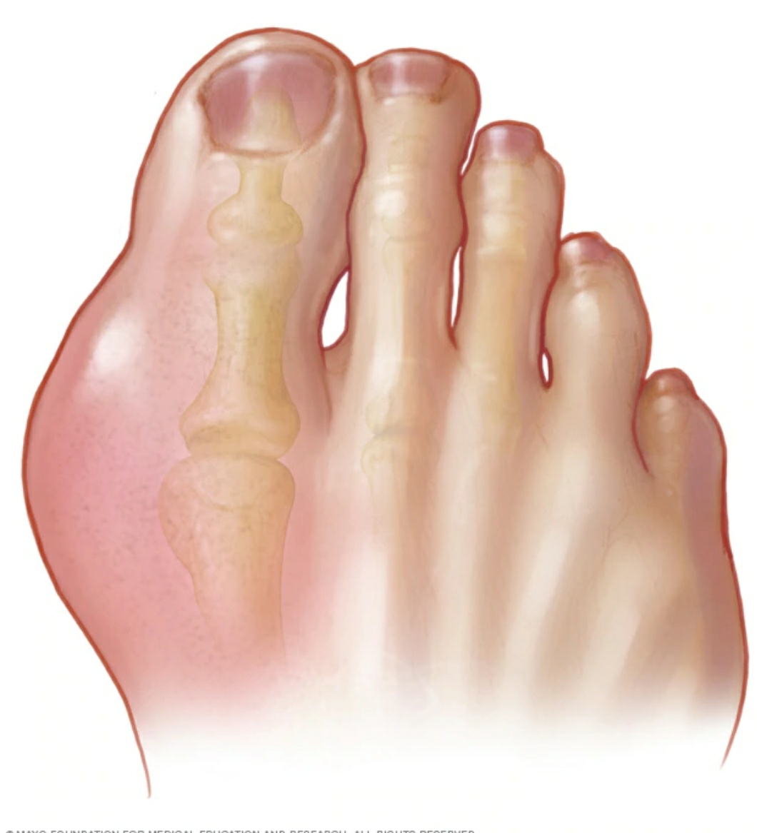 WHAT IS GOUT ?
IT IS A FORM OF ARTHRITIS CHARAC... main image