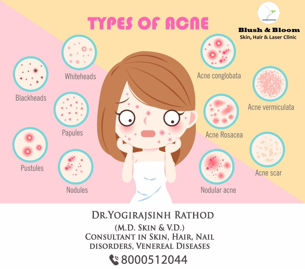 Get rid of acne, spots and achieve the flawless sk... main image