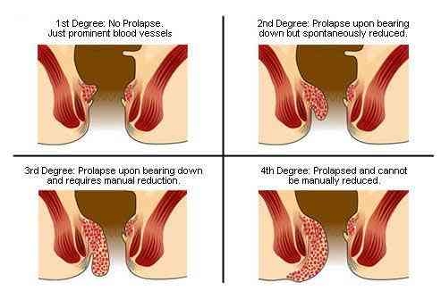 Piles symptoms differs grade wise.
First degree pi... main image