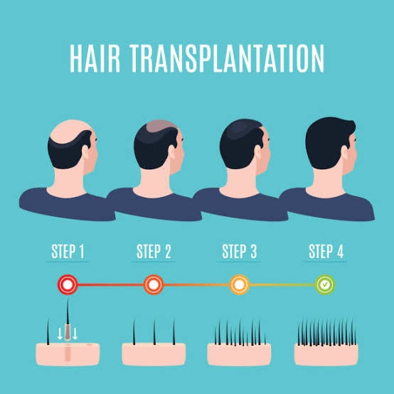 Get your crown back with hair transplant....
Lipos... main image