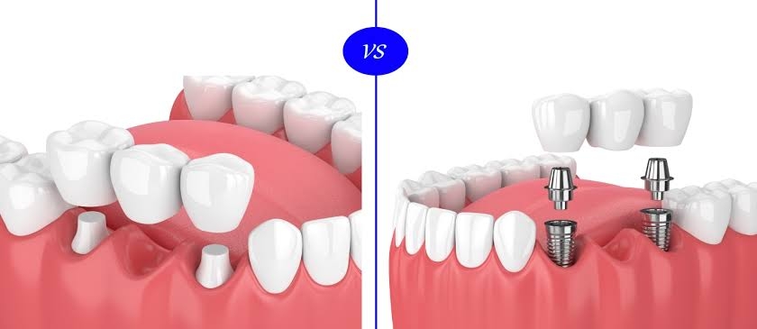 If you have lost your tooth because of tooth de... main image