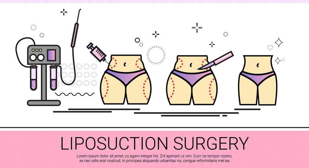 Get the best shape in short time with help of lipo... main image