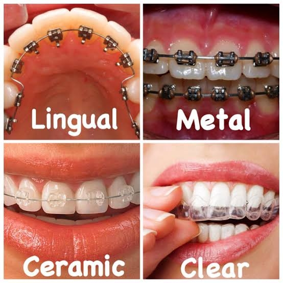 Braces treatment is magical tool for anyone who... main image