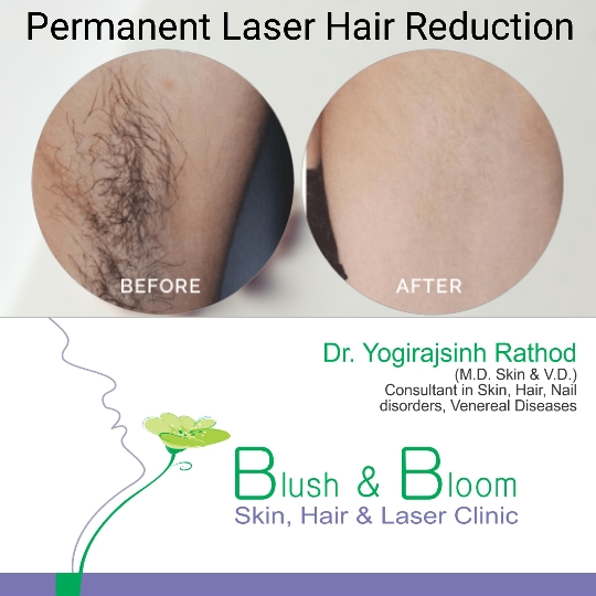 Get rid of unwanted hair with our milesman diode l... main image