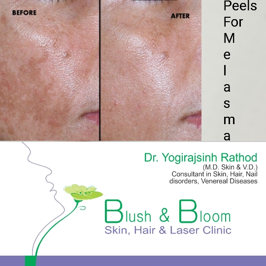 Melasma responds if treated and taken care of prop... main image