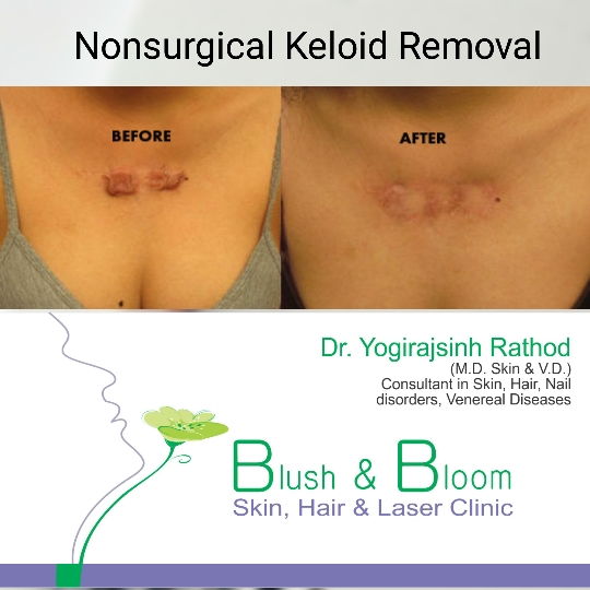 Keloid is overgrowth of skin and deep tissue at... main image