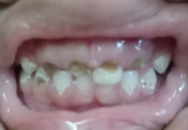 Baby teeth are as important as adult teeth. If ... main image